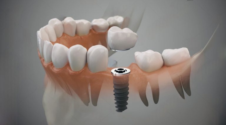Benefits of Dental Implants