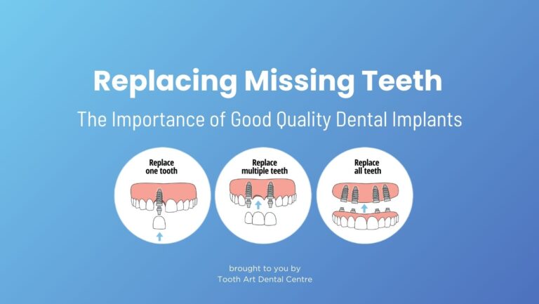 Replacing Missing Teeth: The Importance of Good Quality Dental Implants