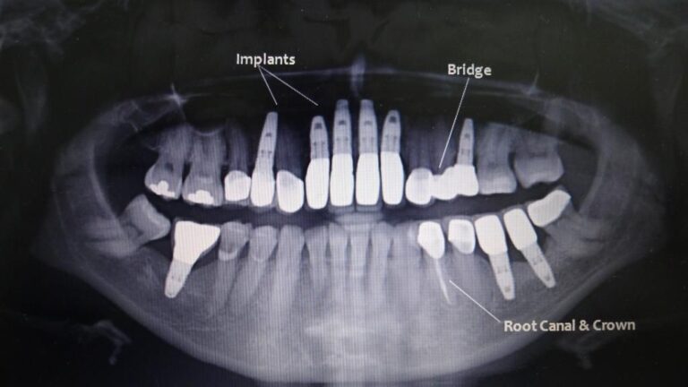 Full Mouth Rehabilitation X-Ray
