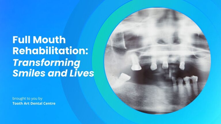 Full Mouth Rehabilitation: Transforming Smiles and Lives