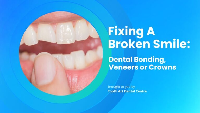 Fixing a Broken Smile: Dental Bonding, Veneers or Crowns