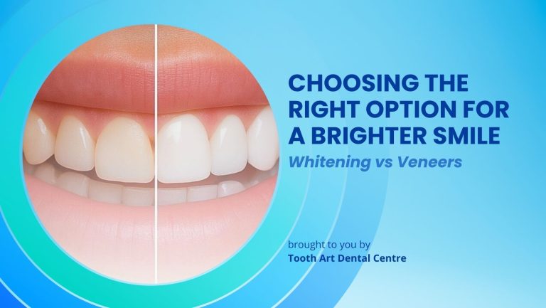 Choosing the Right Option for a Brighter Smile:  Whitening vs Veneers